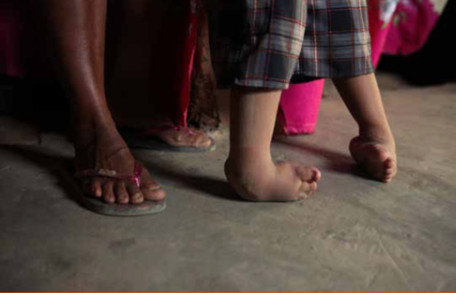 Un menor de edad, junto a su madre, muestra las deformaciones que tiene en los huesos de sus pies. Se presume que la enfermedad se debe al haber ingerido agua de los pozos contaminados.